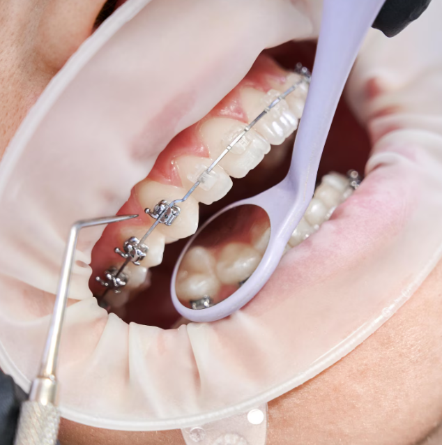 Braces and Orthodontics