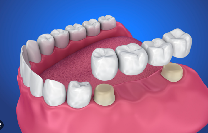 Dental Bridges