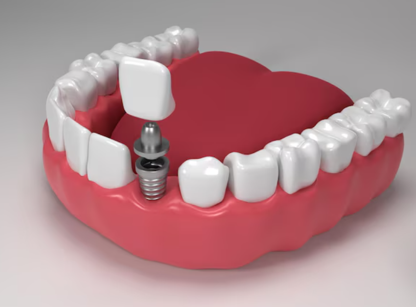 dental implants-faq