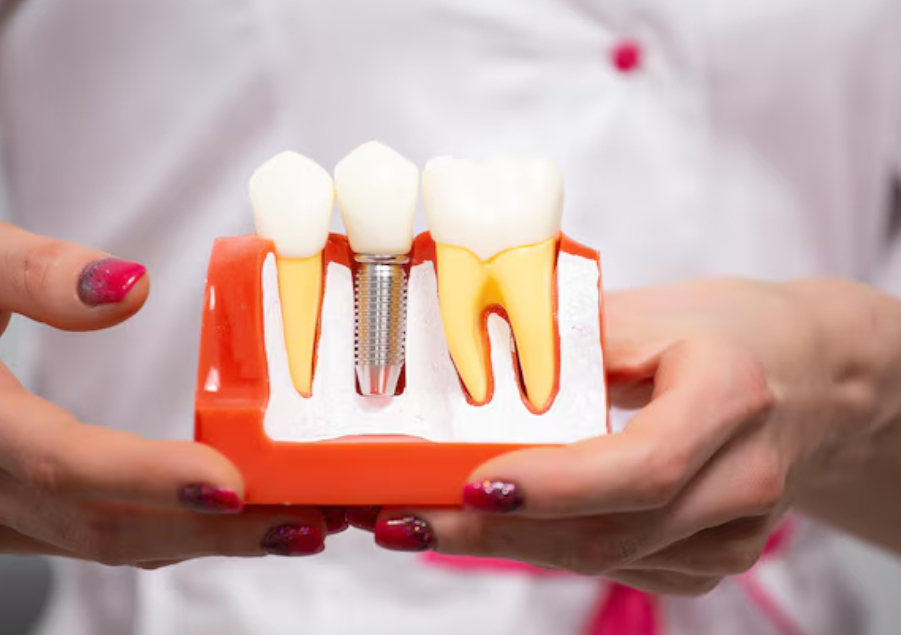 dental-implants