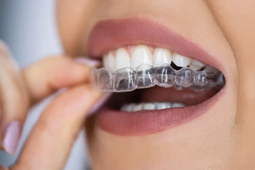 Invisalign treatment
