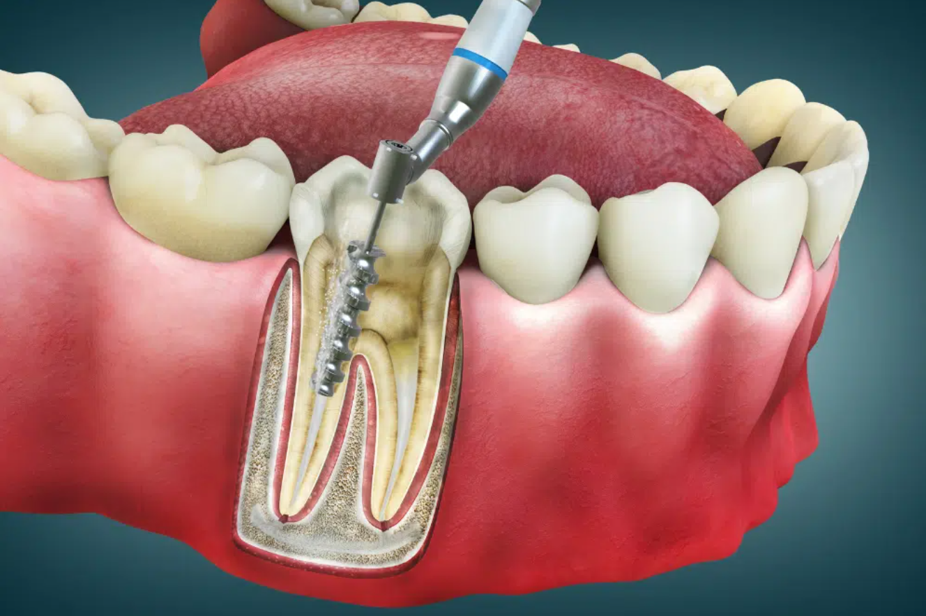 root canal treatment cost