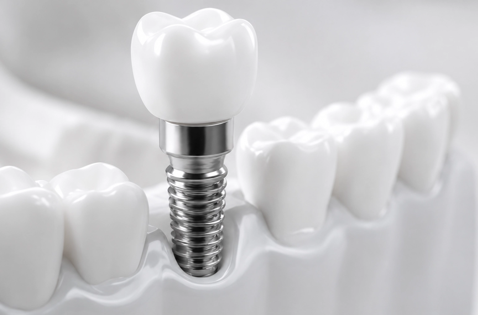Dental Implants Croydon