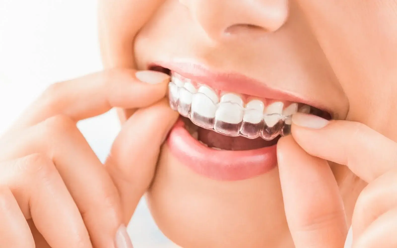 Invisalign in croydon