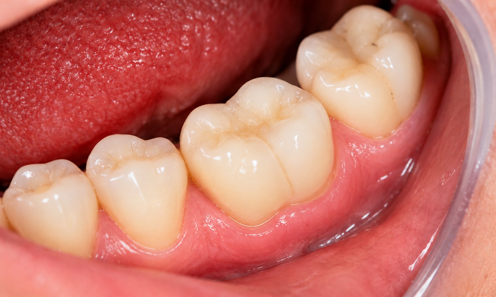 After Root Canal Treatment Croydon