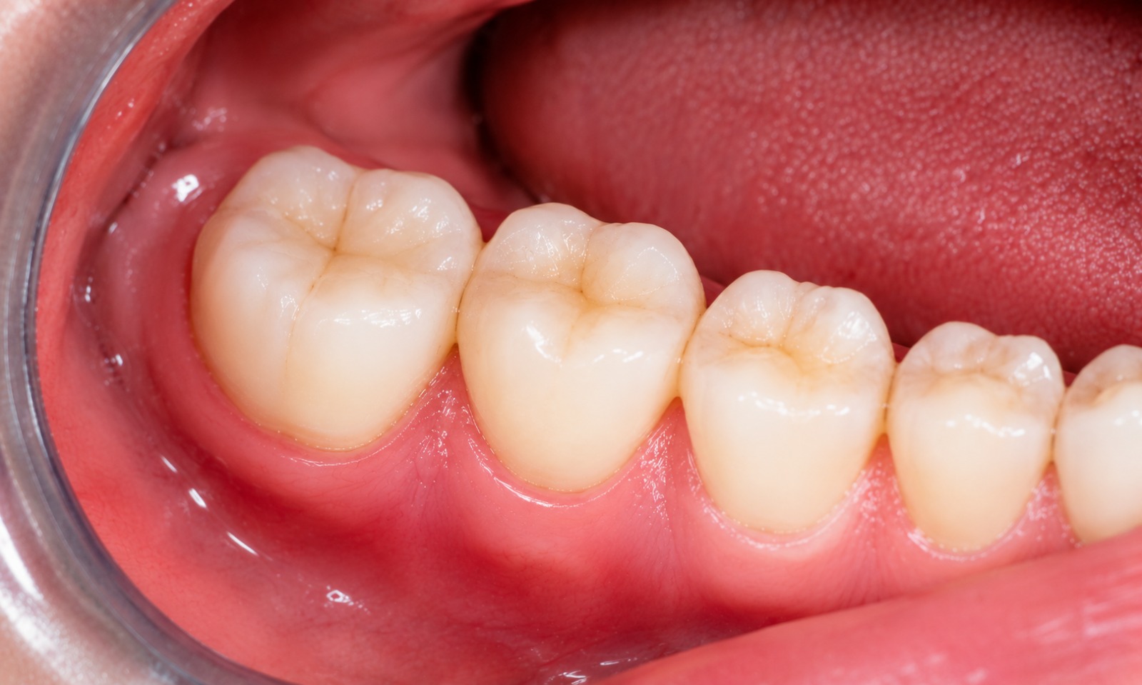 After Root Canal Treatment in Croydon