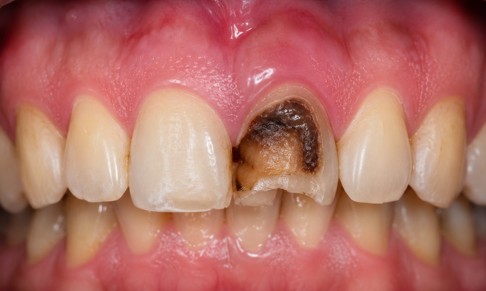 Before Root Canal Treatment
