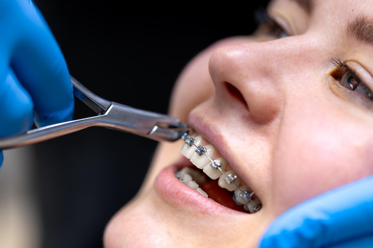 Teeth Straightening with Meta Braces in Croydon