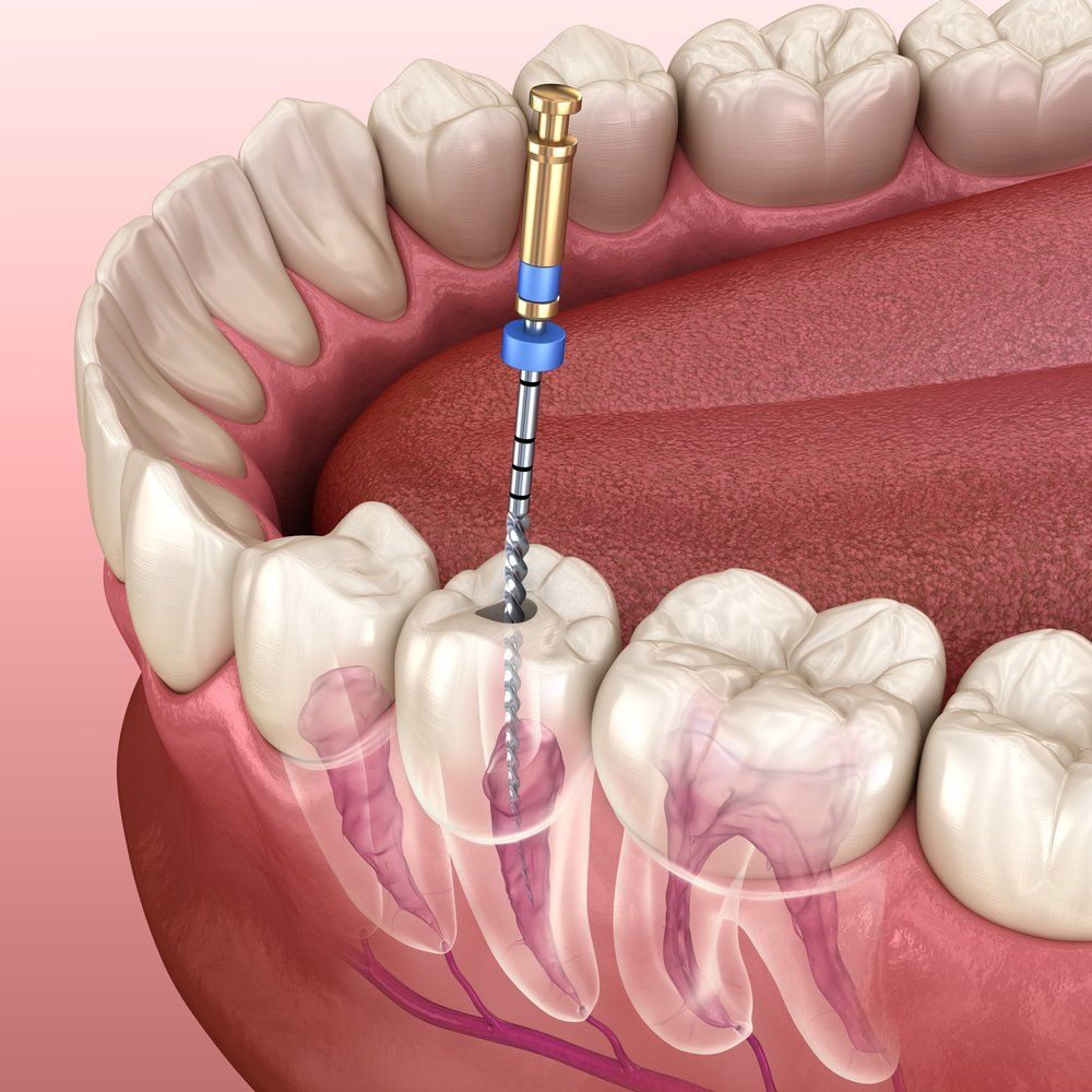 Root Canal Treatment in Croydon