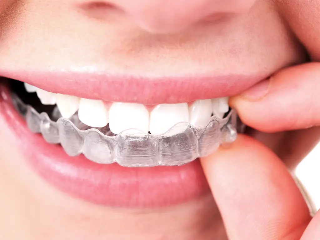 Best Invisible Braces London - Best Dentist in Canning Town - iCare Dental - 2025