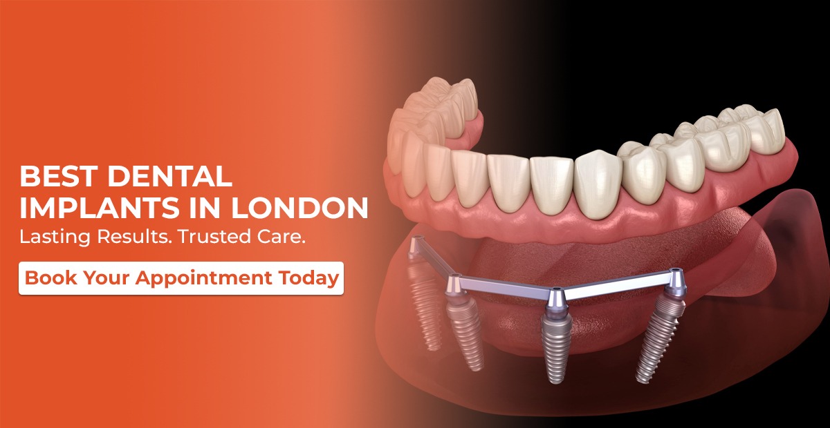Best Dental Implants in London