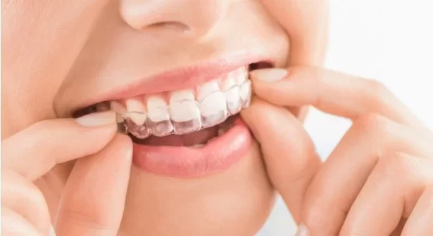 invisalign-cost-in-east-london