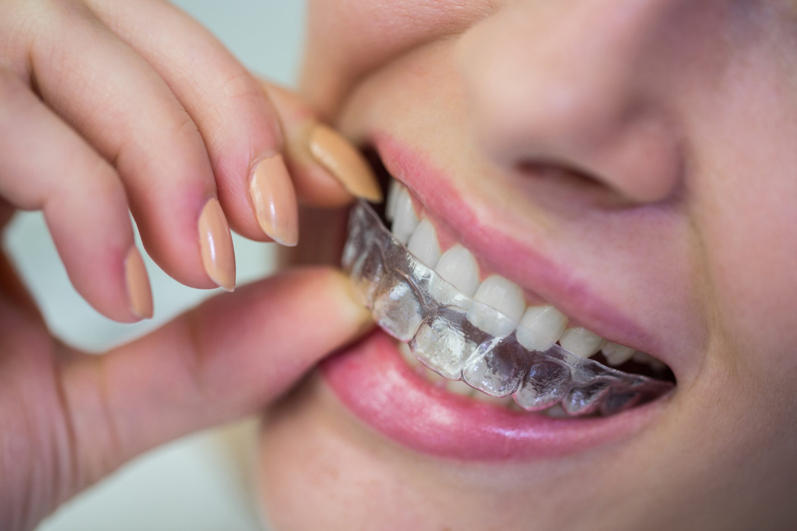 Invisalign Offers in London