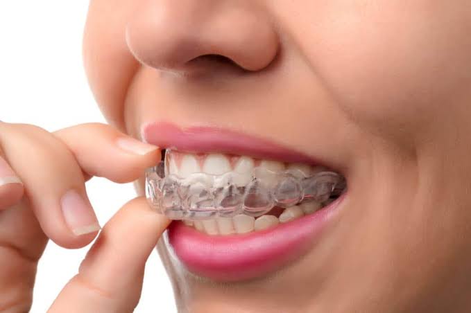 Orthodontic treatment